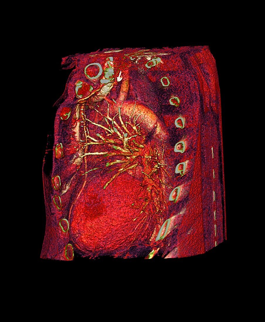 Coronary artery bypass graft,CT scan