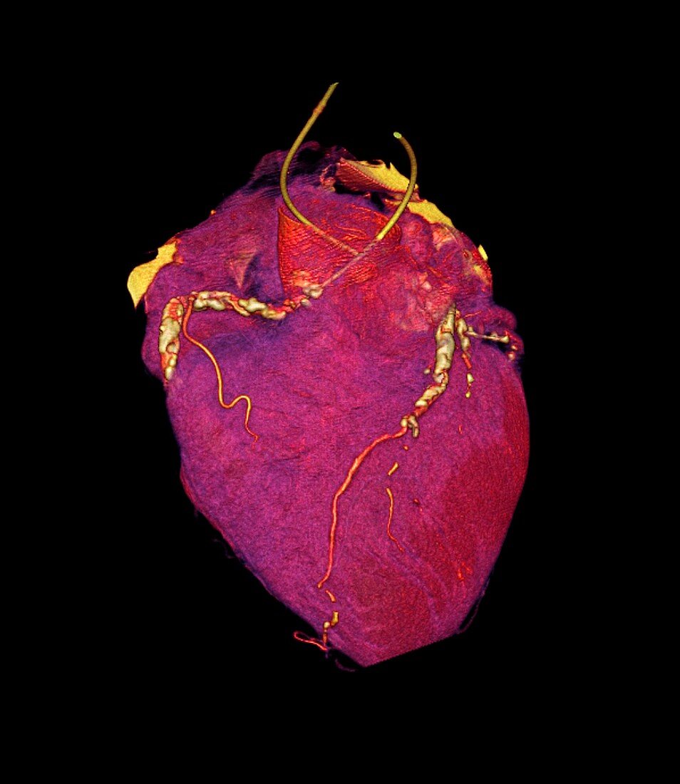 Human heart,CT scan