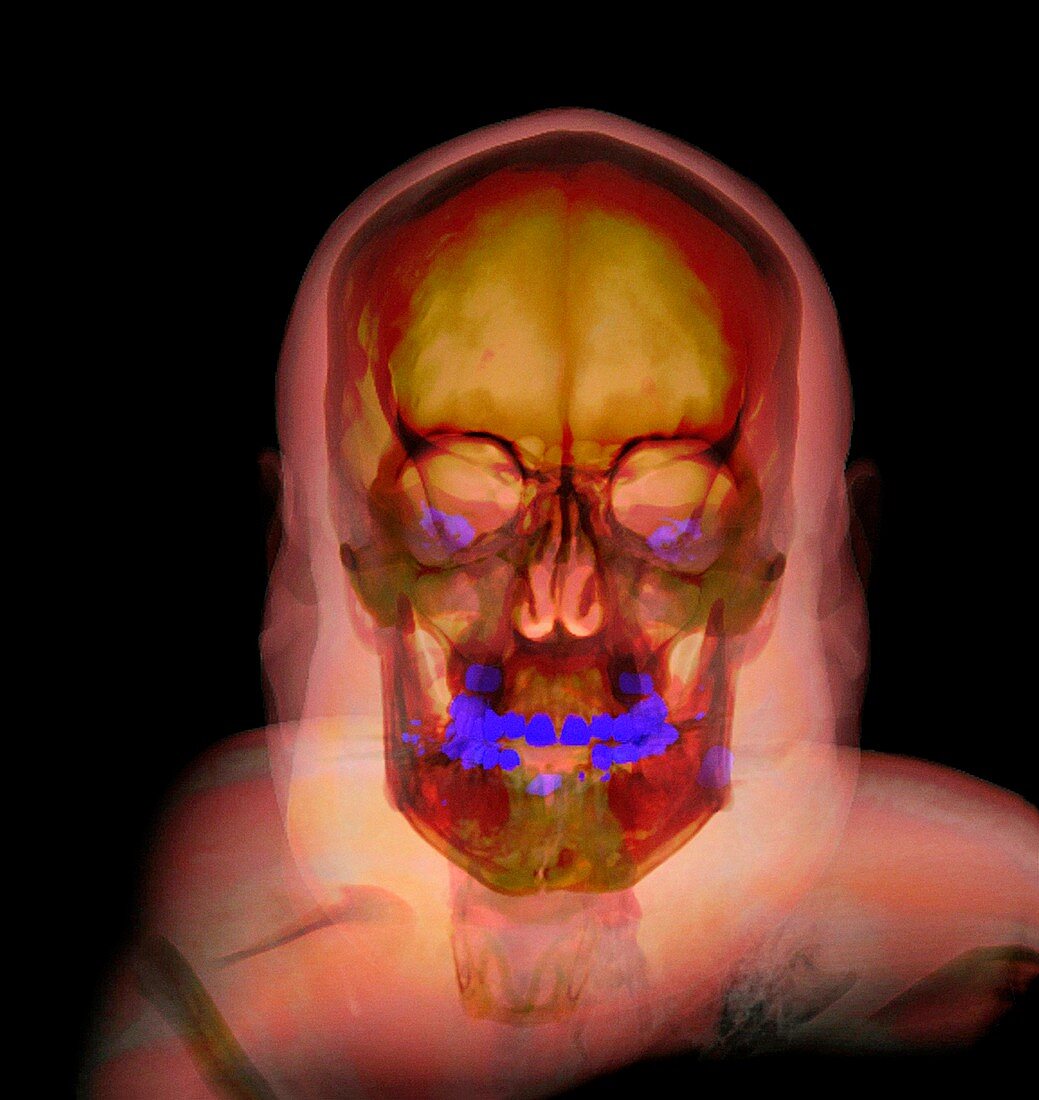Human head and skull,CT scan