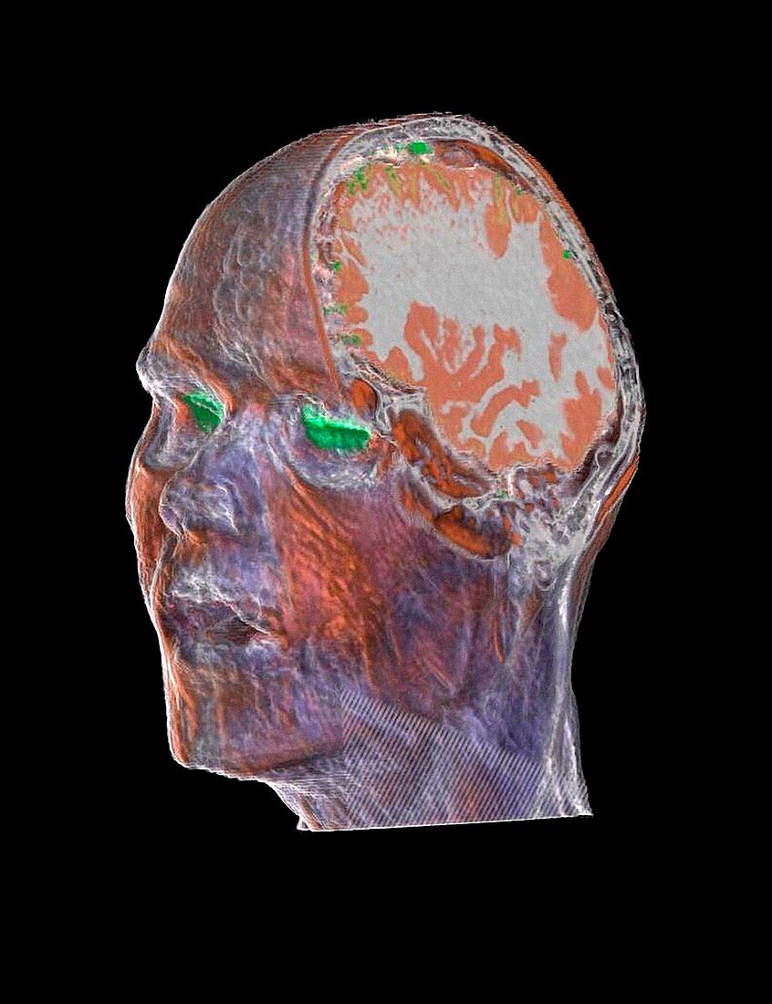 Human head and brain,CT scan