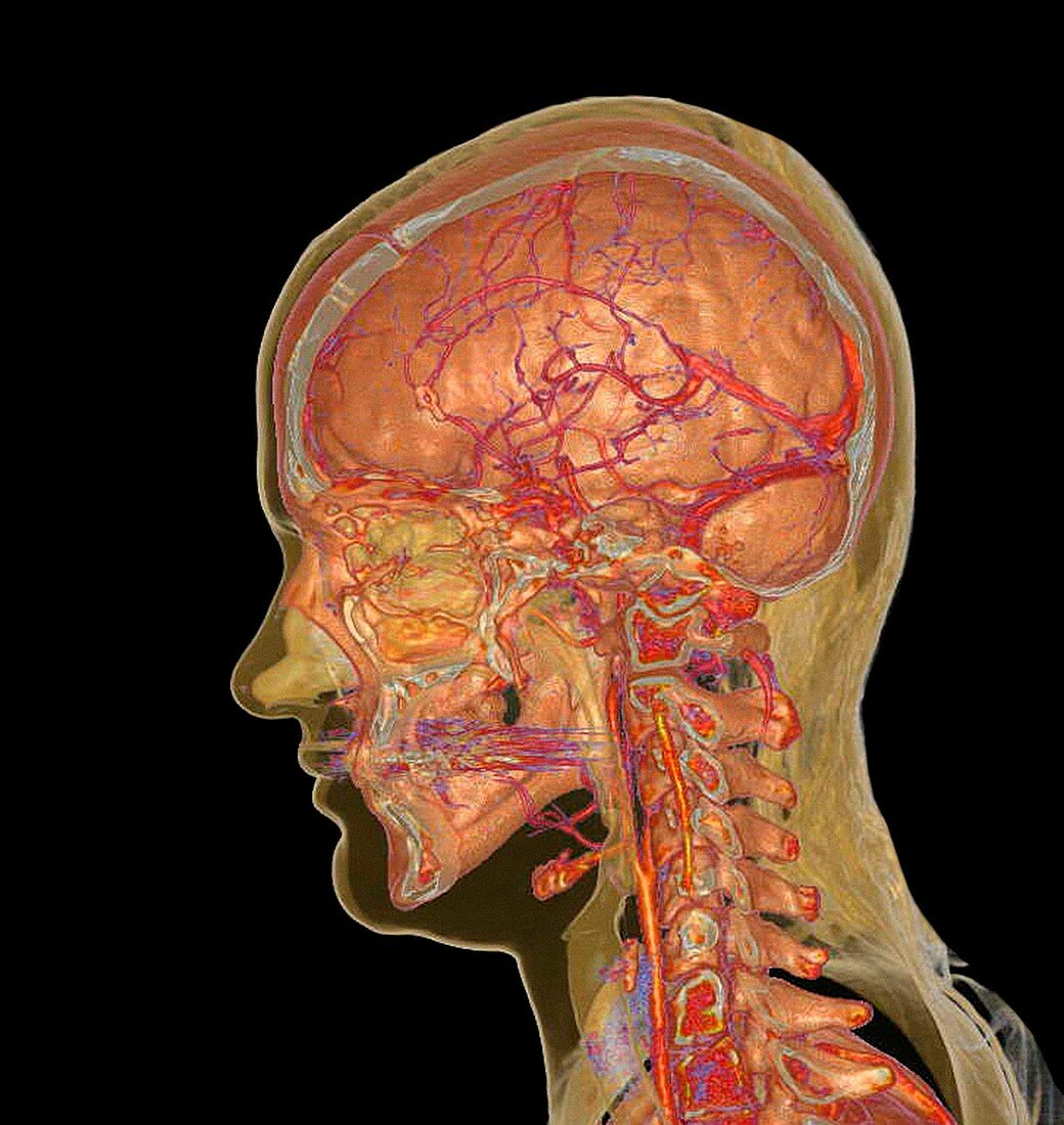 Brain,spine and blood vessels,CT scan