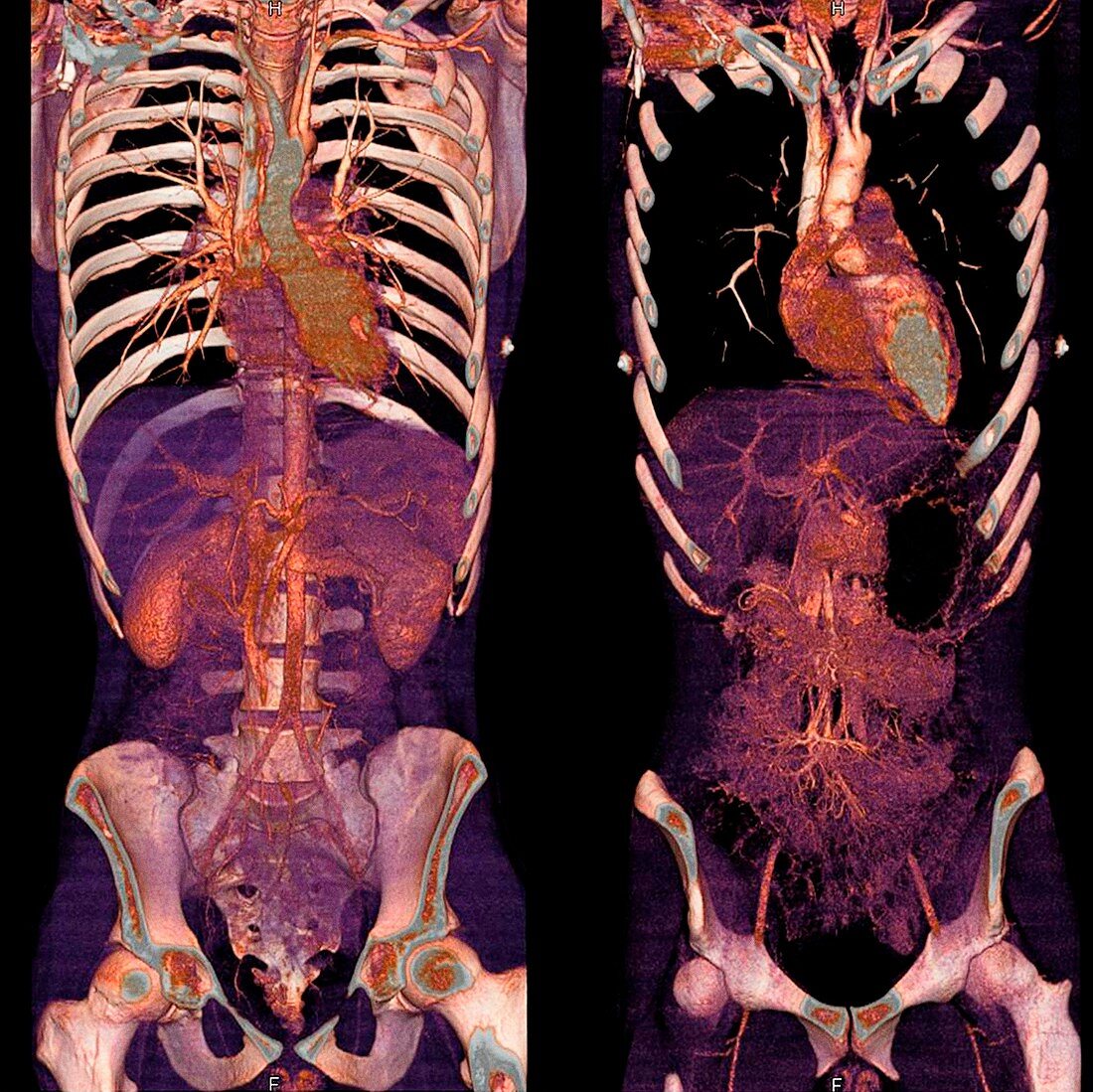 Chest and abdomen,CT scans