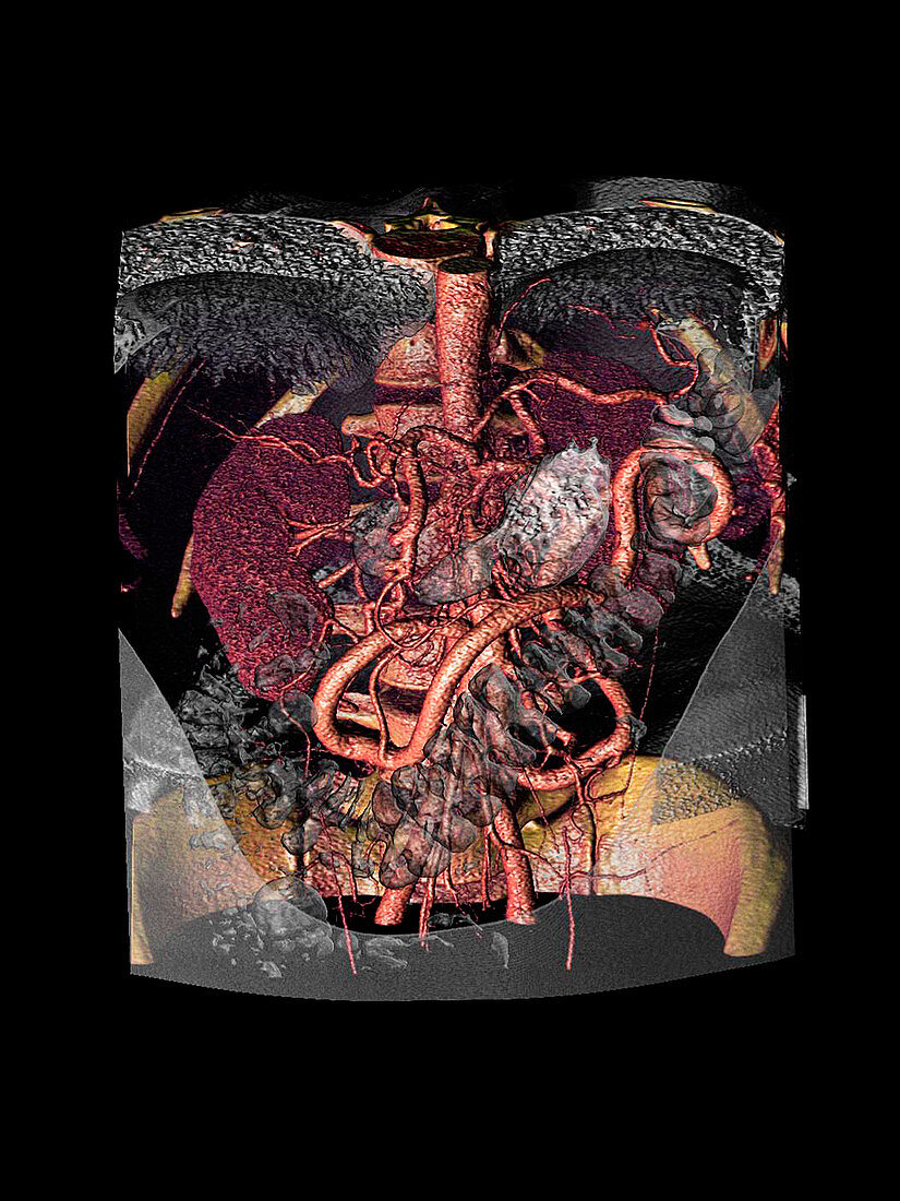 Distended mesenteric artery,CT scan