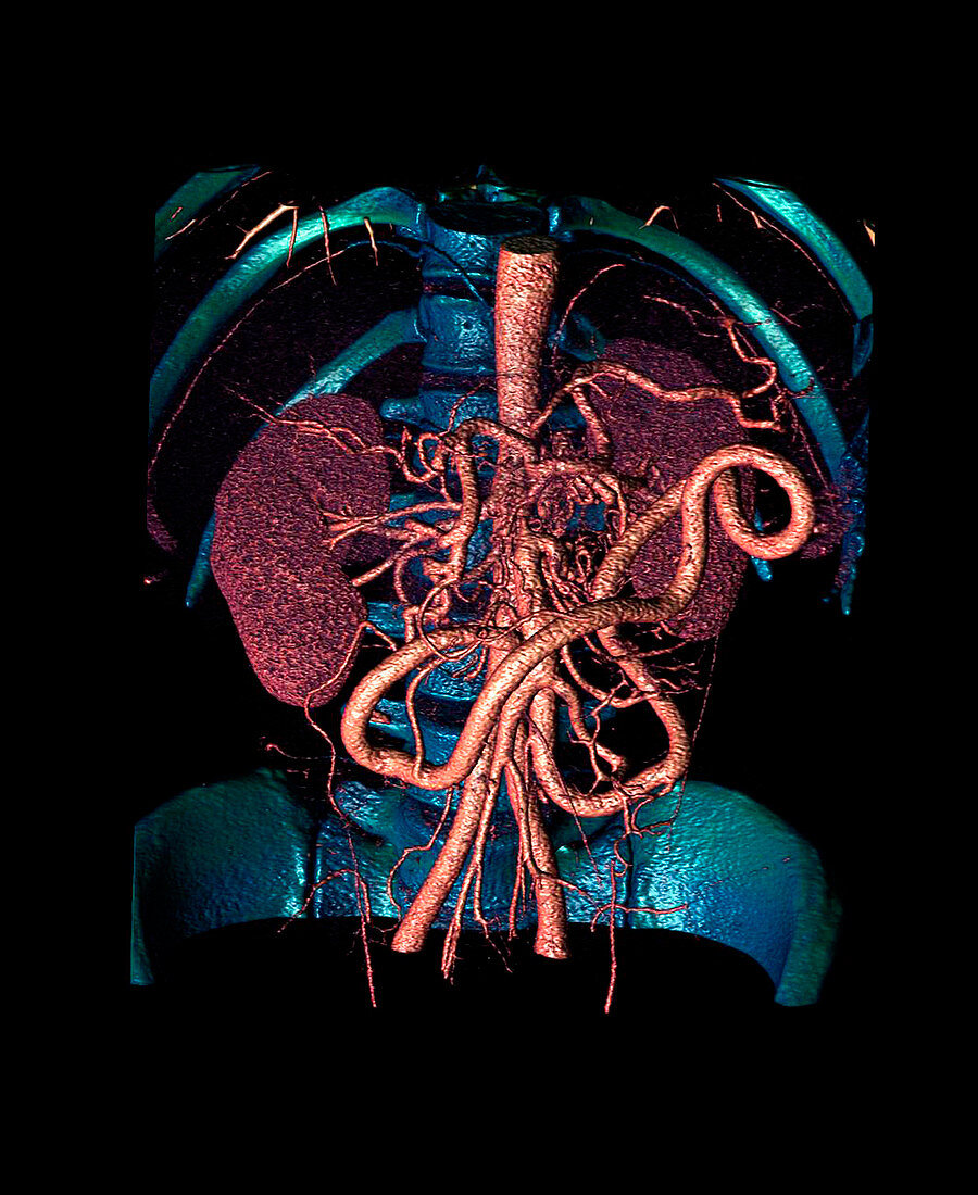 Distended mesenteric artery,CT scan