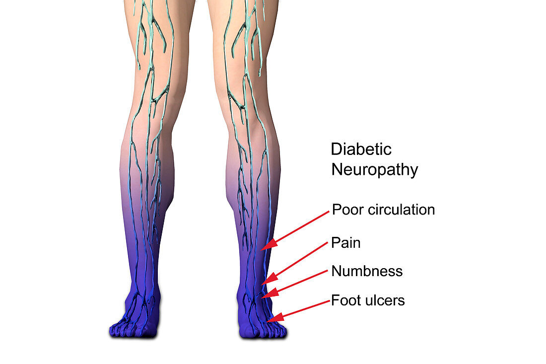 Diabetic Neuropathy,illustration
