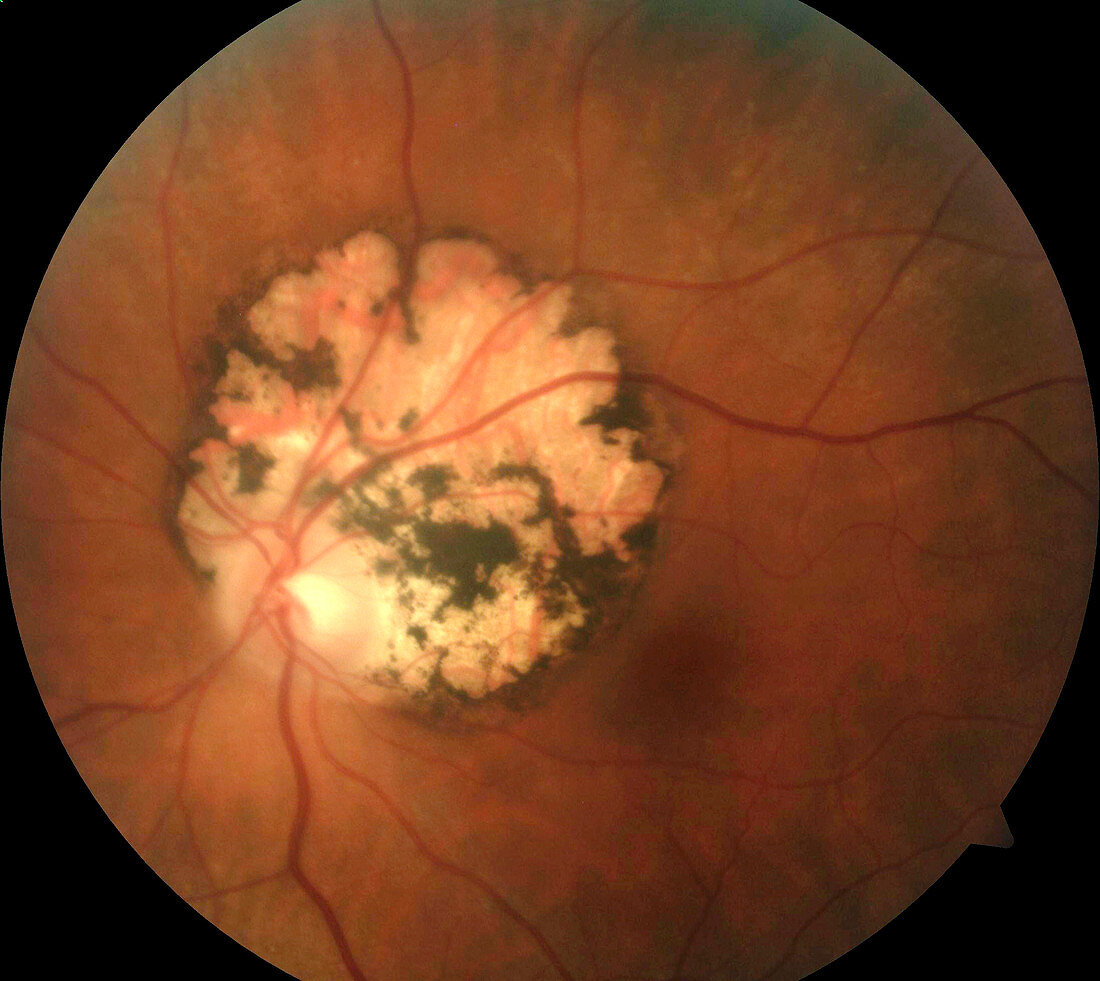 Toxoplasmosis in the retina