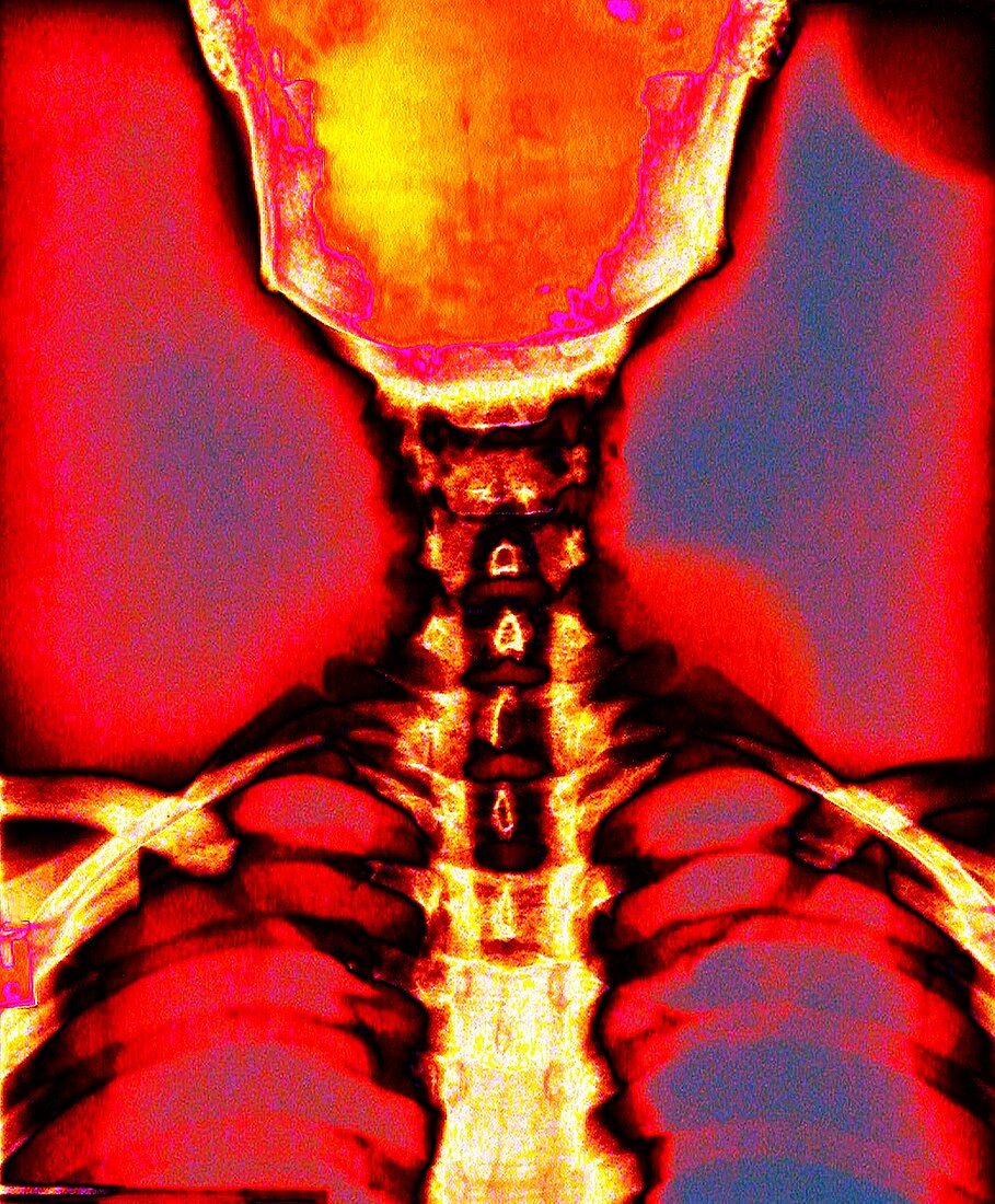 Neck vertebrae and skull,coloured X-ray