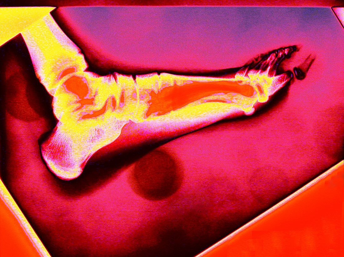 Foot,coloured X-ray
