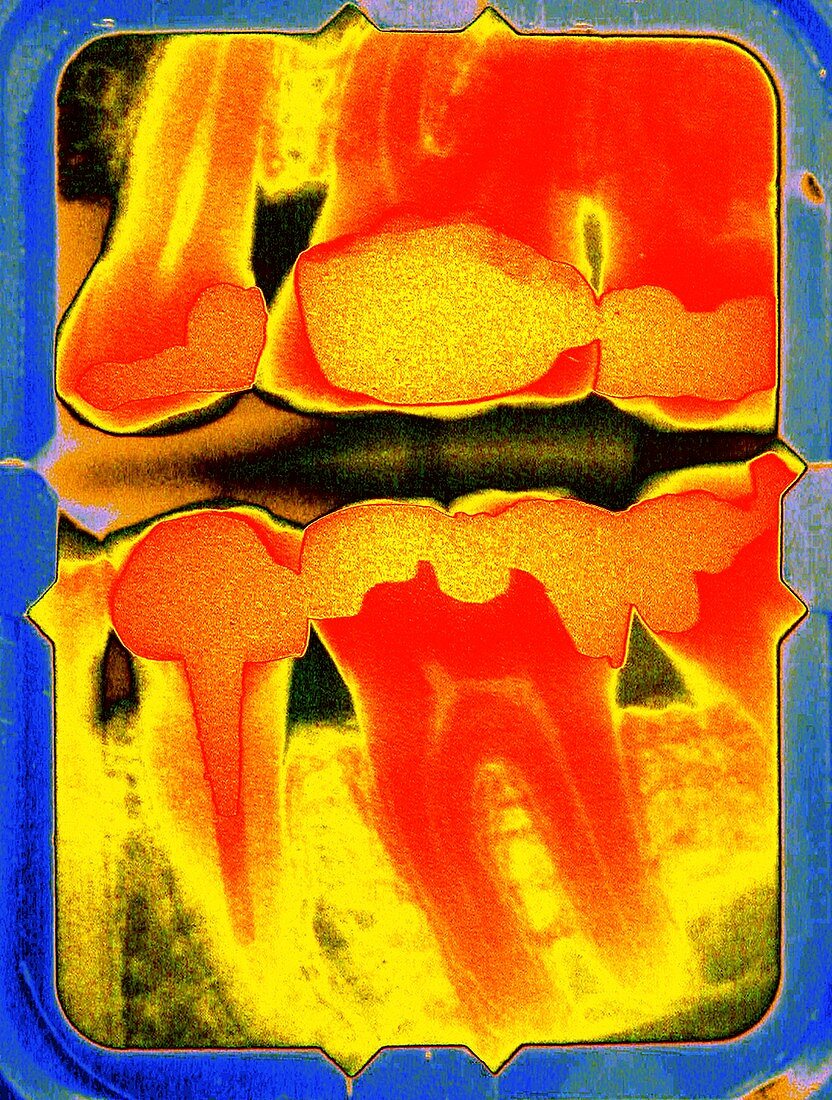 Teeth and fillings,coloured dental X-ray