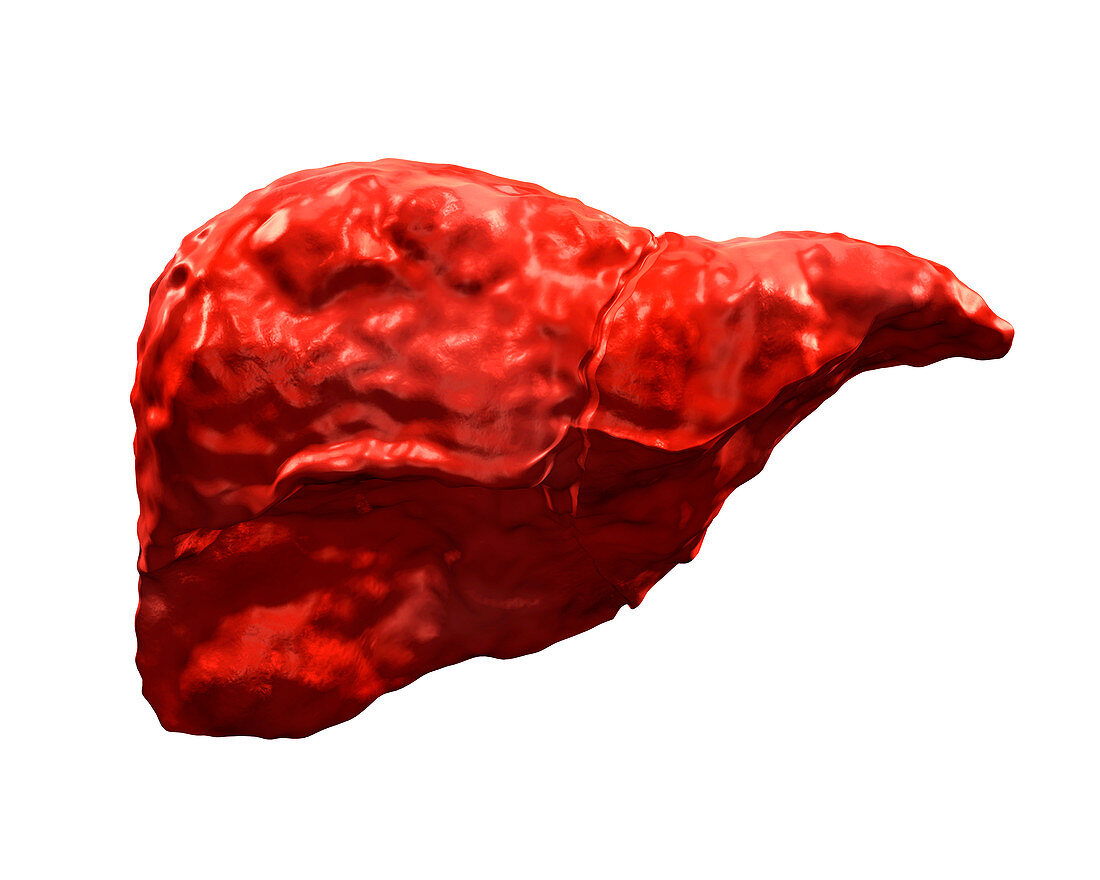 Cirrhotic liver,illustration