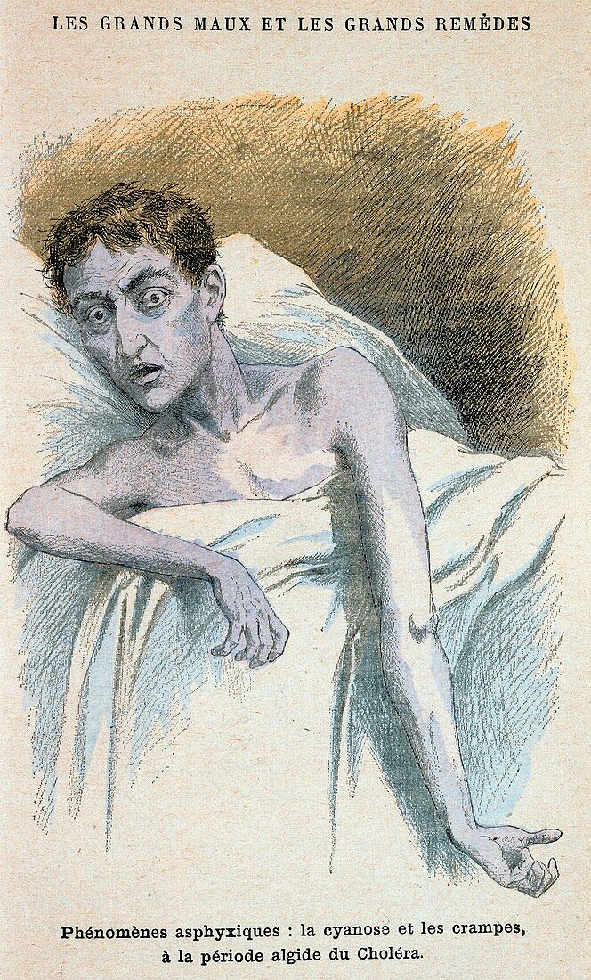 Patient in typical cholera attitude