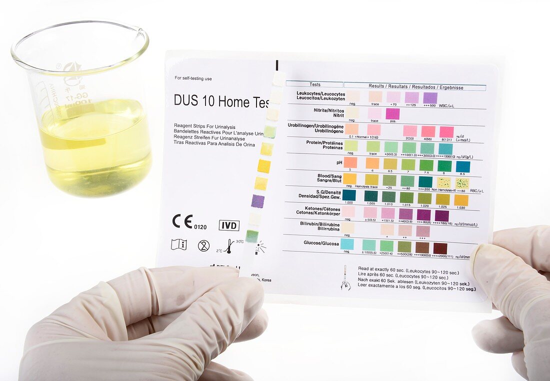 Home urine test,abnormal result