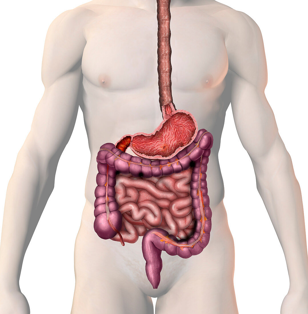 Peptic ulcers,illustration