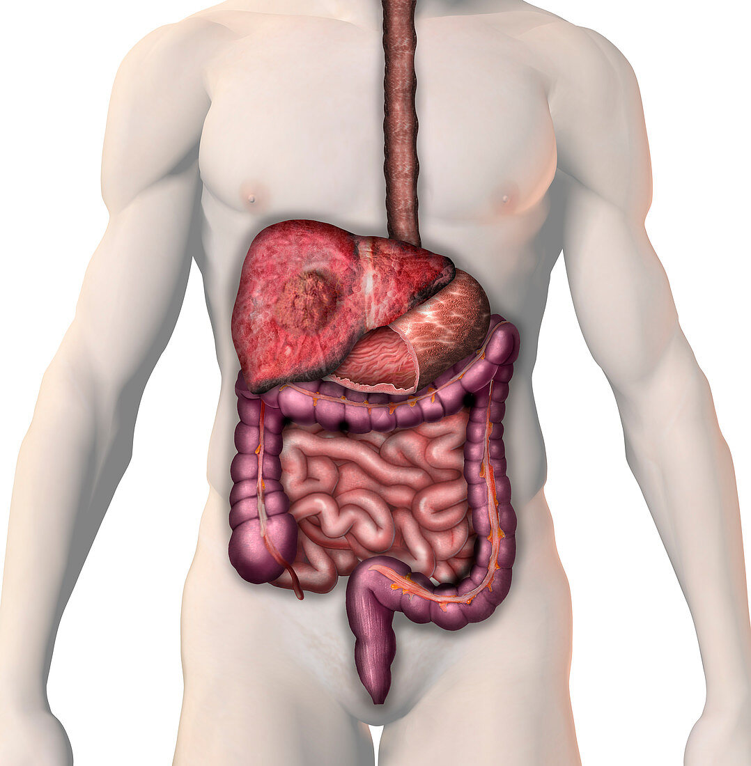 Cancer of the Liver,illustration