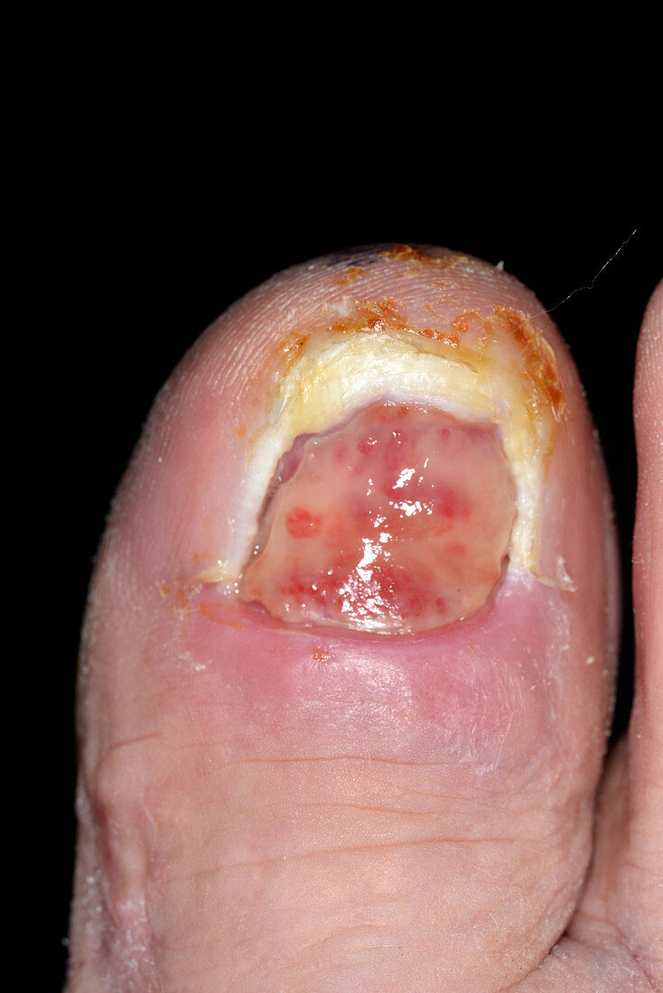 Infected wound after bone surgery