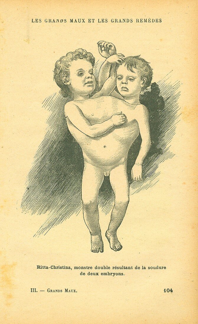 Conjoined twins,illustration