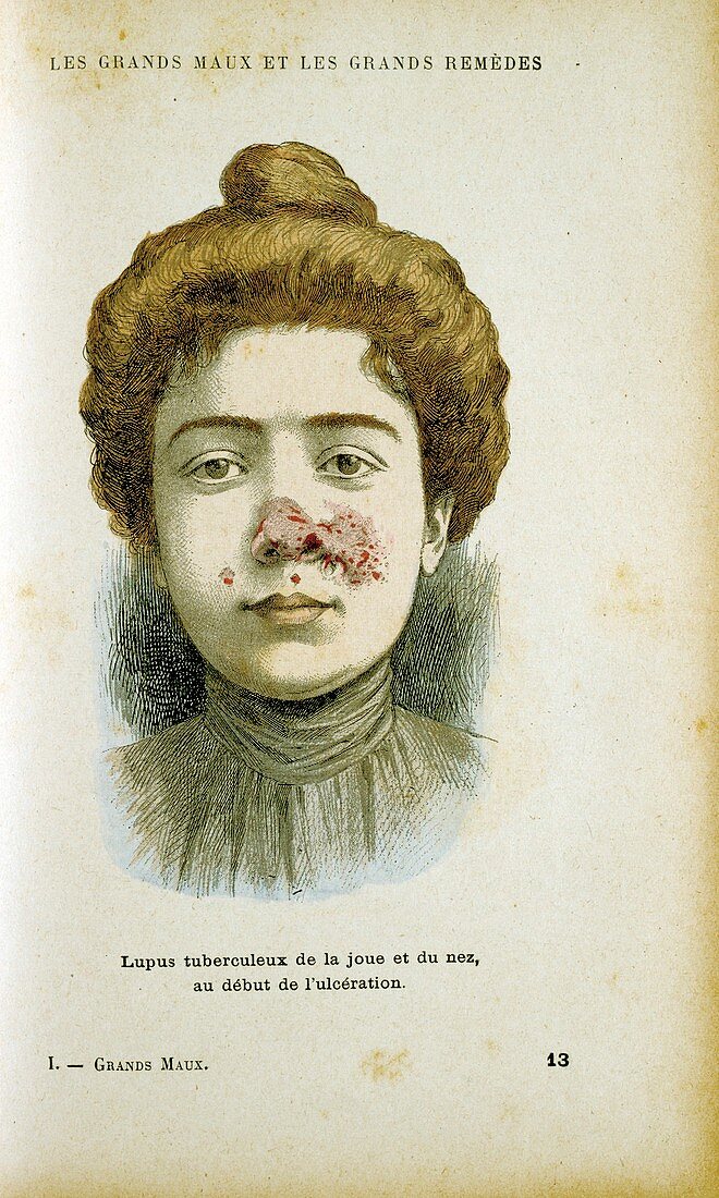 Woman with lupus vulgaris