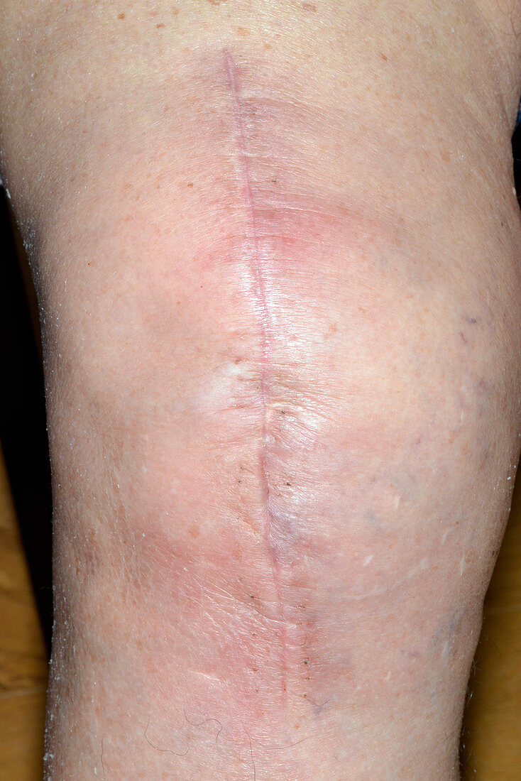 Infected total knee replacement wound