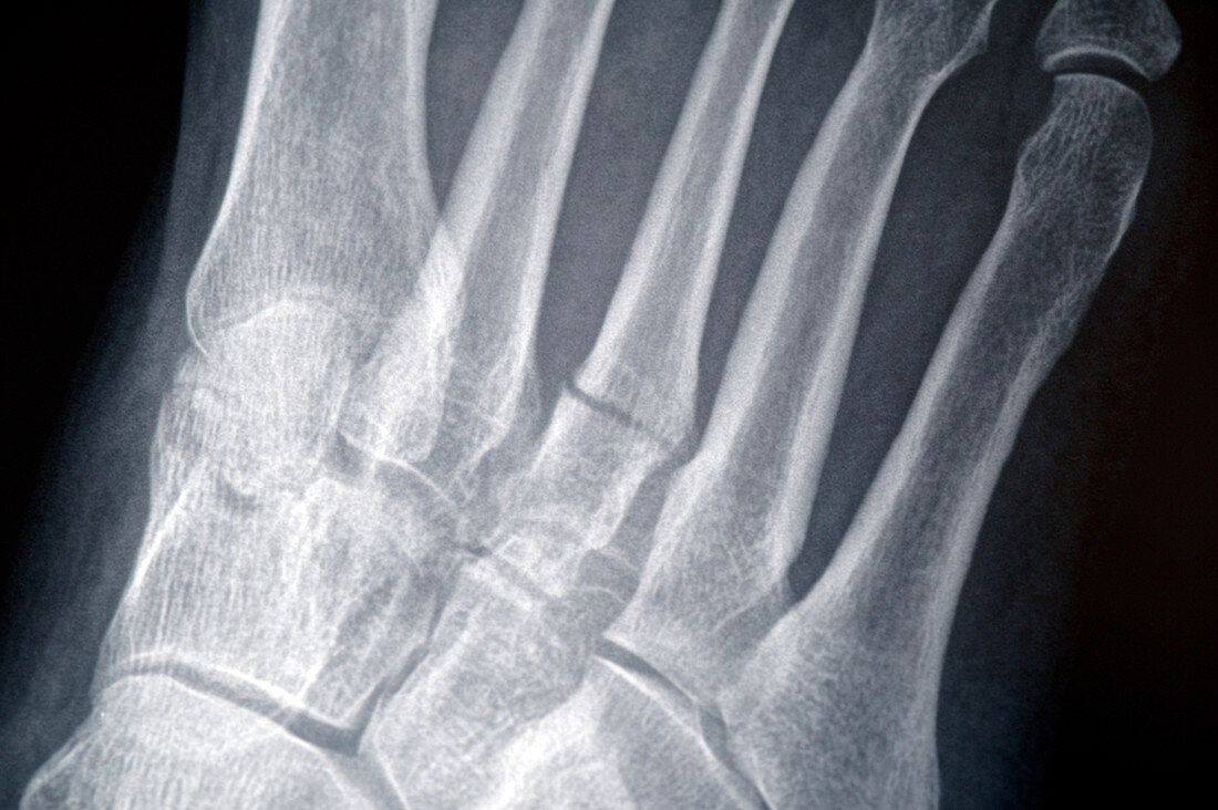 Broken toe,X-ray