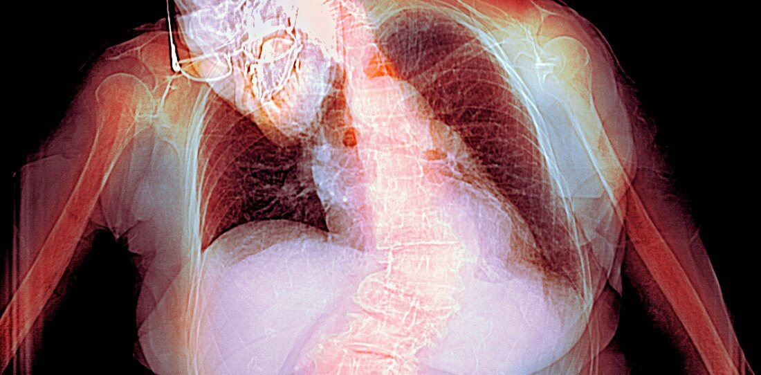 Spinal curvature,X-ray