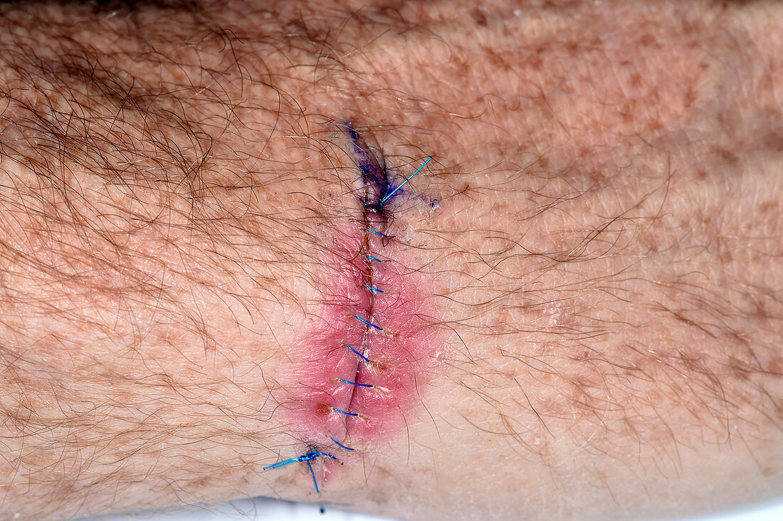 Infected wound from skin cancer removal