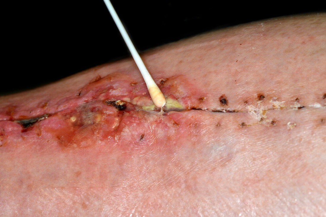 Infected coronary bypass graft wound