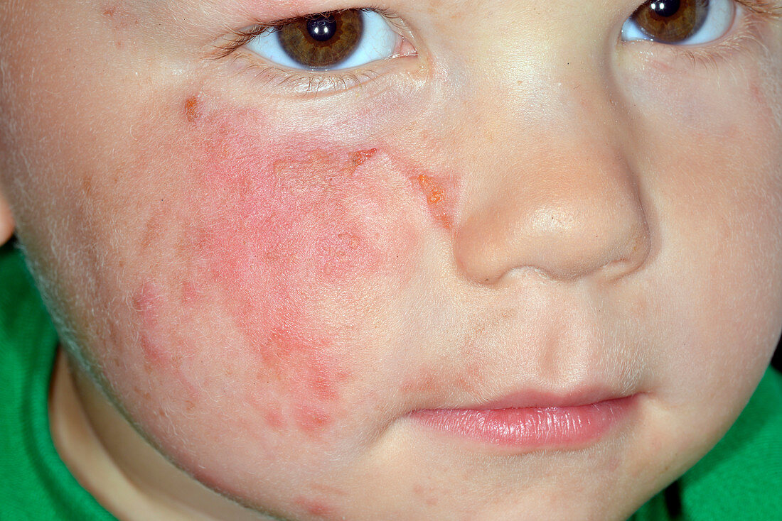 Cellulitis of the face