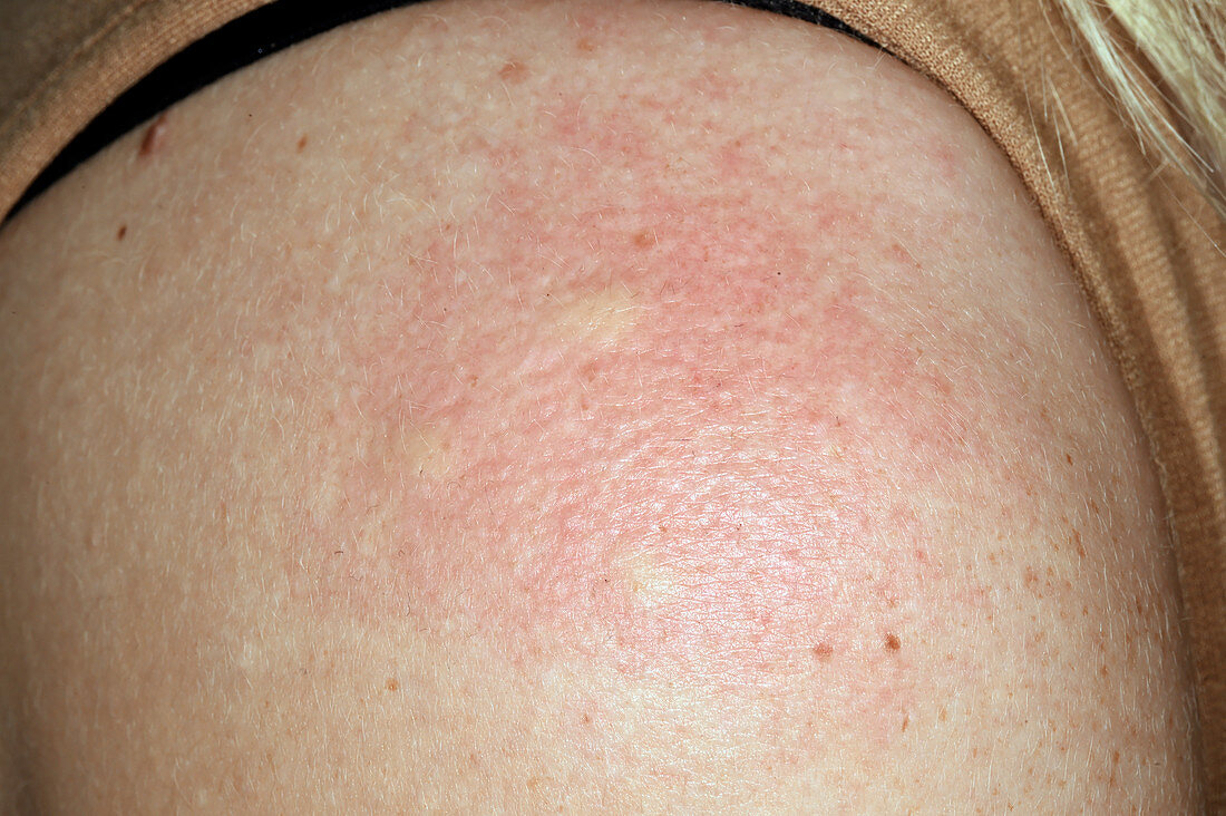 Allergic reaction to spider bite