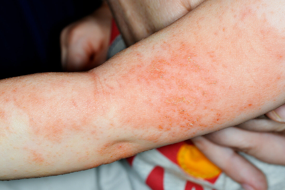 Eczema