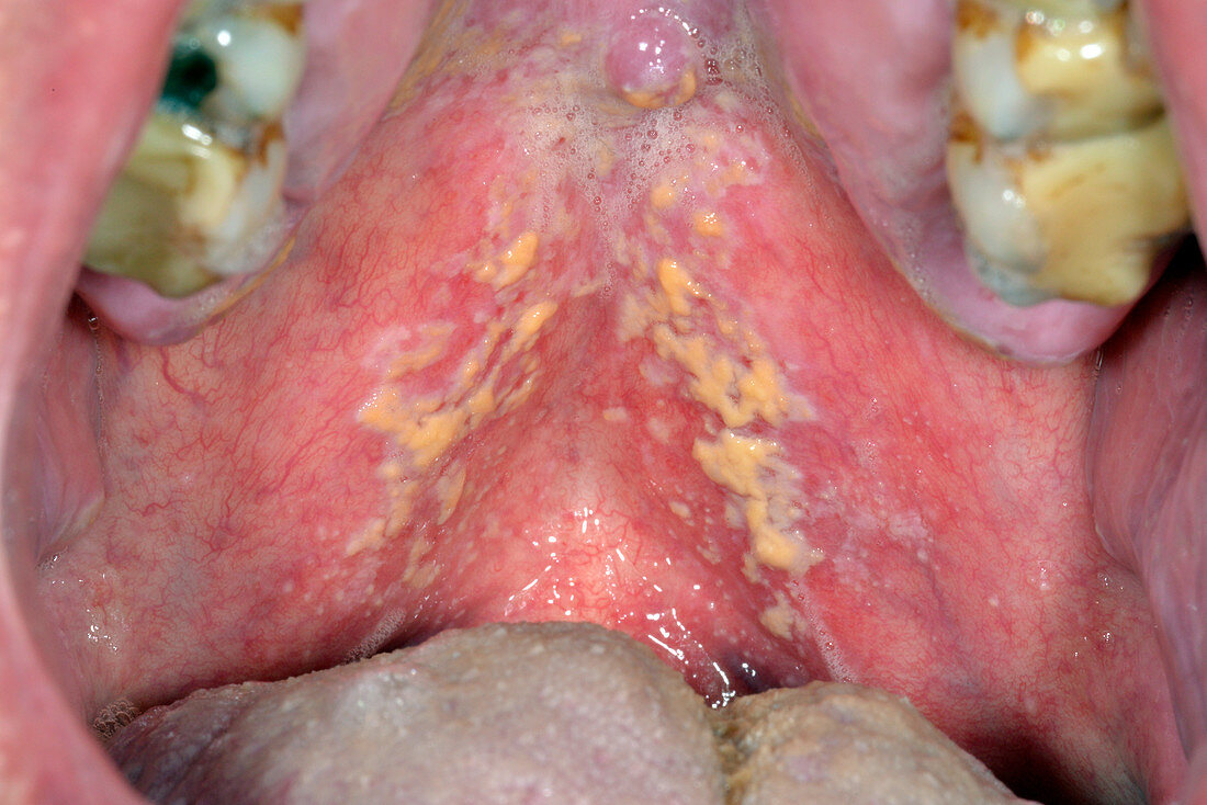 Oral thrush due to inhaled steroids