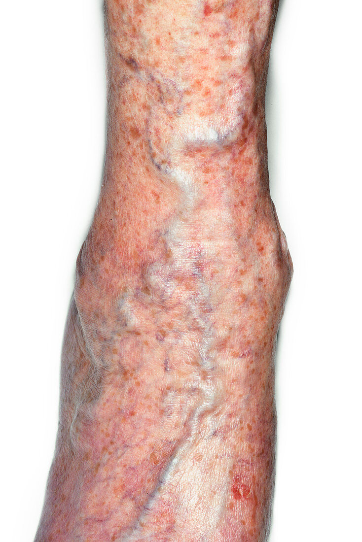 Varicose veins on foot