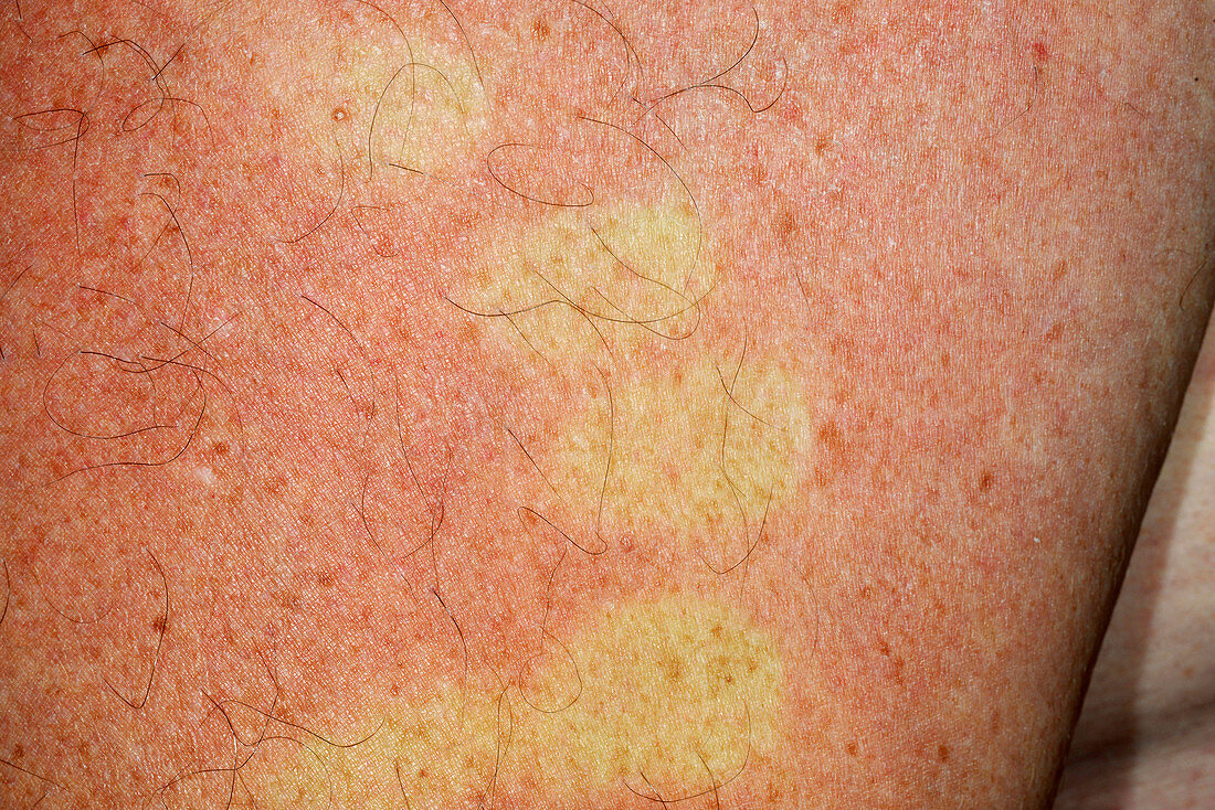 Viral rash