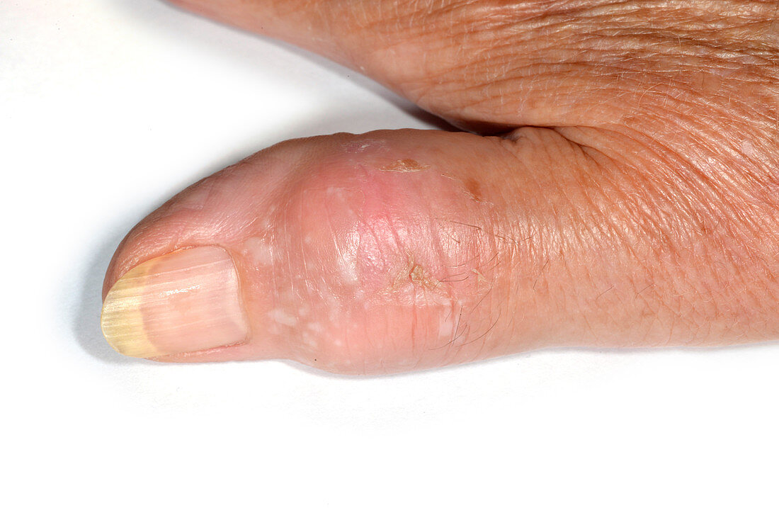 Gout of the thumb