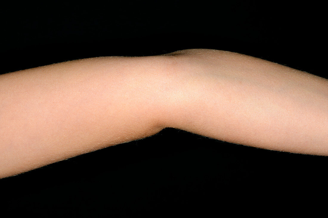 Hypermobility of the elbow