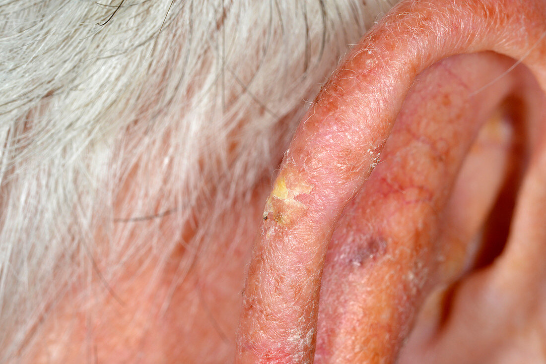 Solar keratosis of the ear