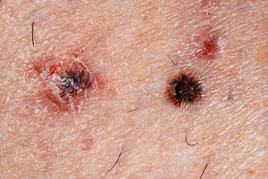 Skin cancer and non-cancerous lesion