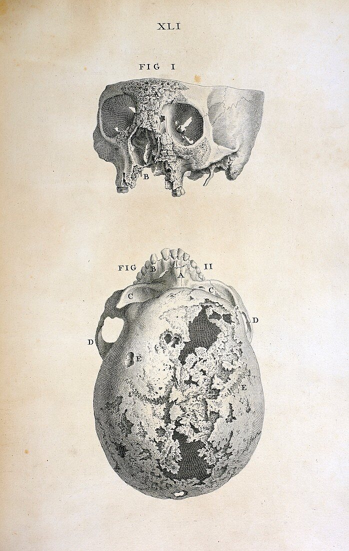 Diseased human skull,18th century