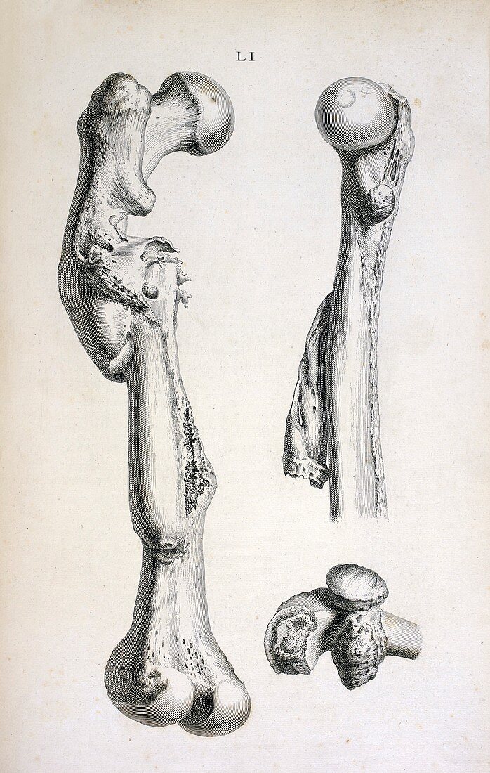 Bone deformities,18th century