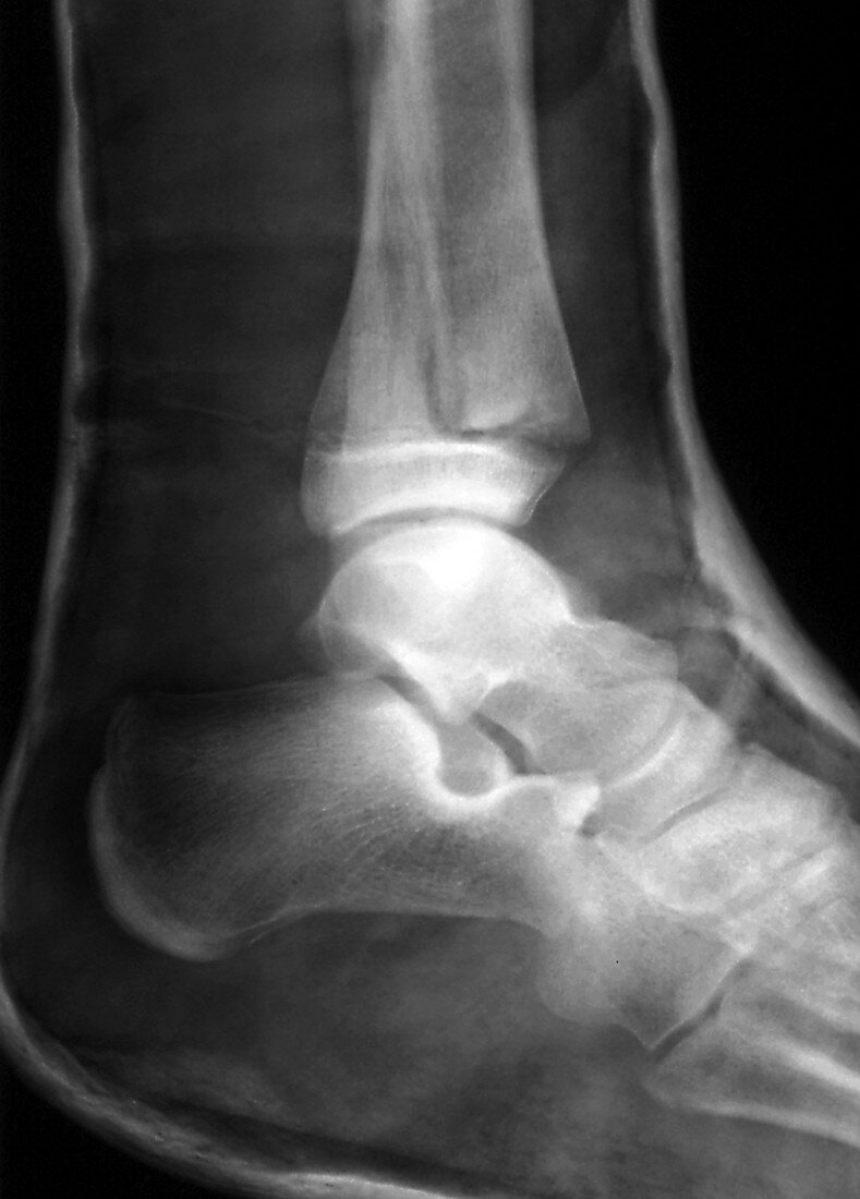 Leg fracture,X-ray