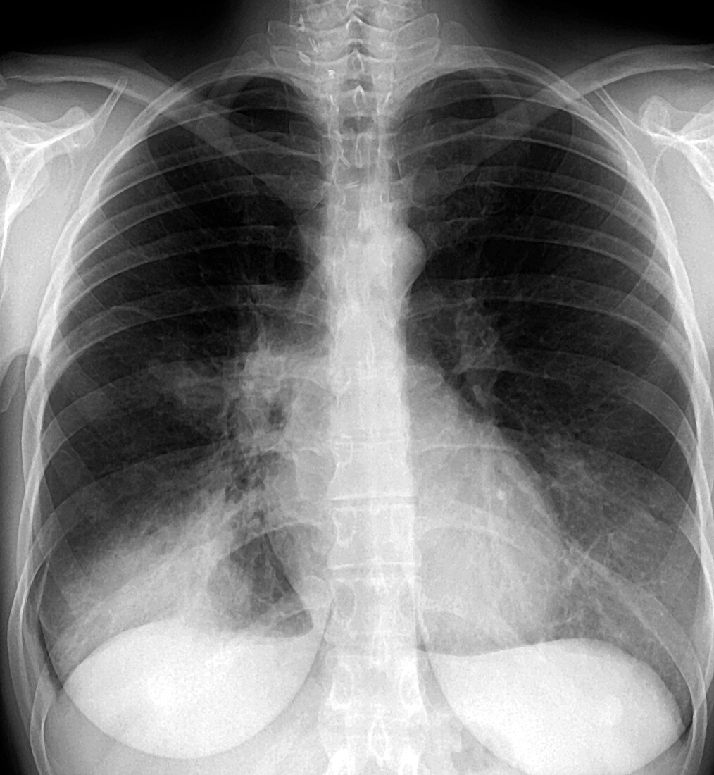 Chest infection,X-ray