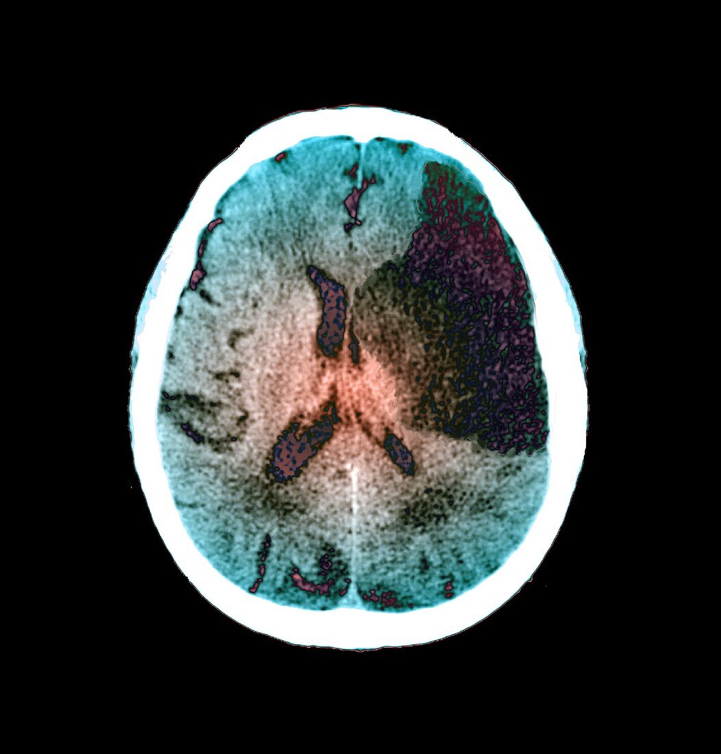 Brain in stroke,CT scan
