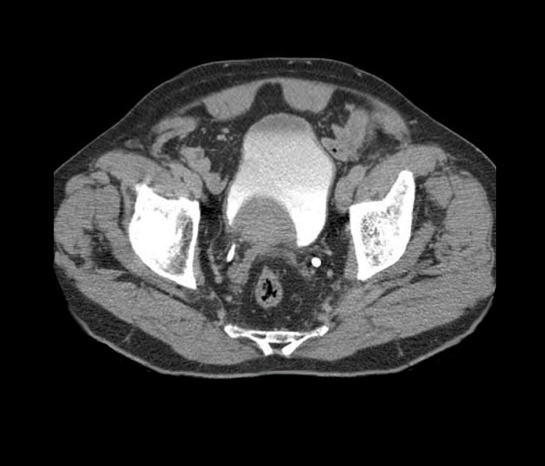 Prostate tumour,CT scan