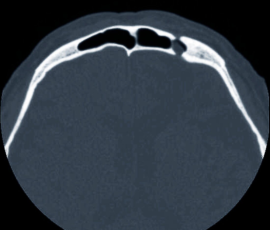 Dural tear following traffic accident,CT