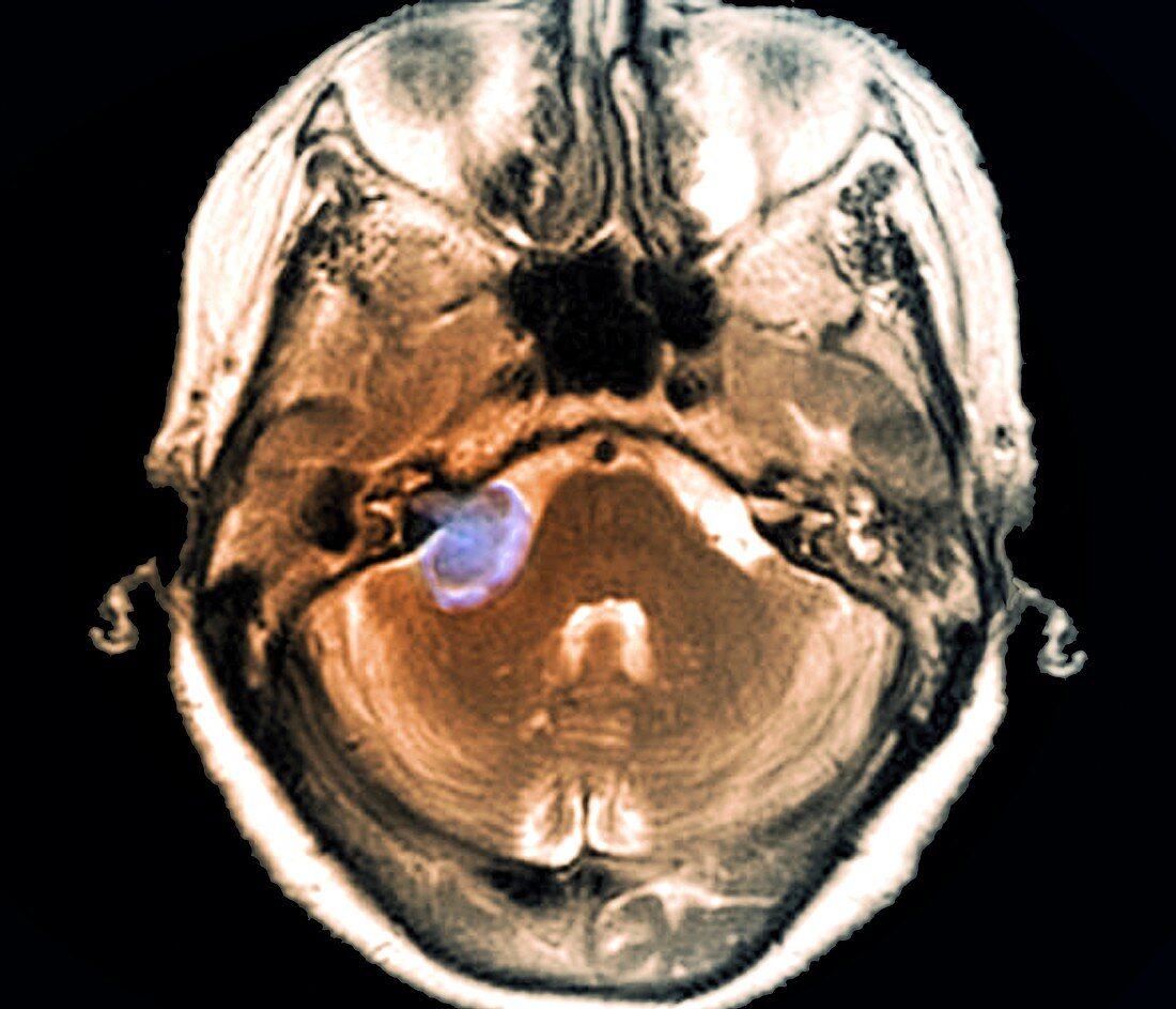 Brain tumour,MRI