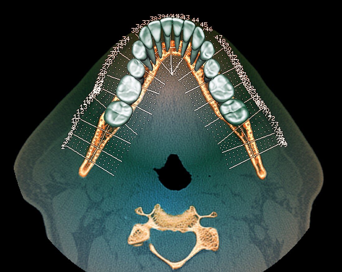 Normal teeth,3D CBCT scan