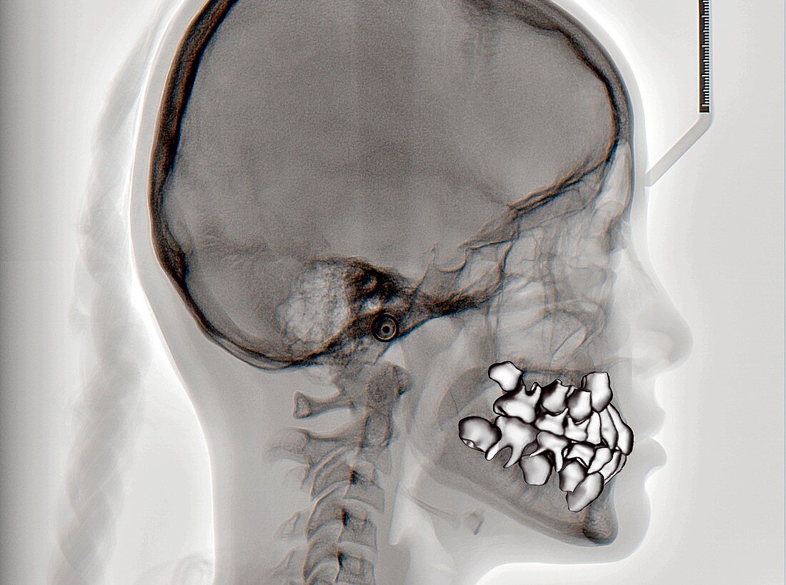 Normal teeth,3D CBCT scan