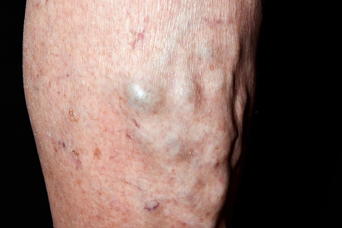 Varicose veins