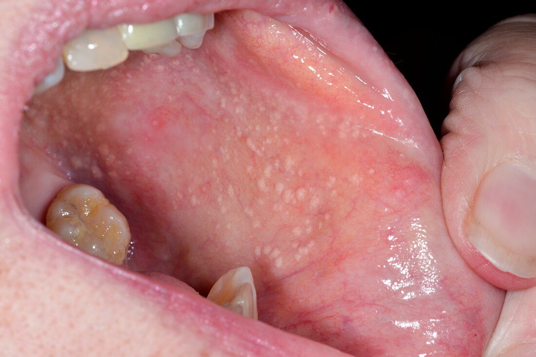 Lichen planus of the mouth