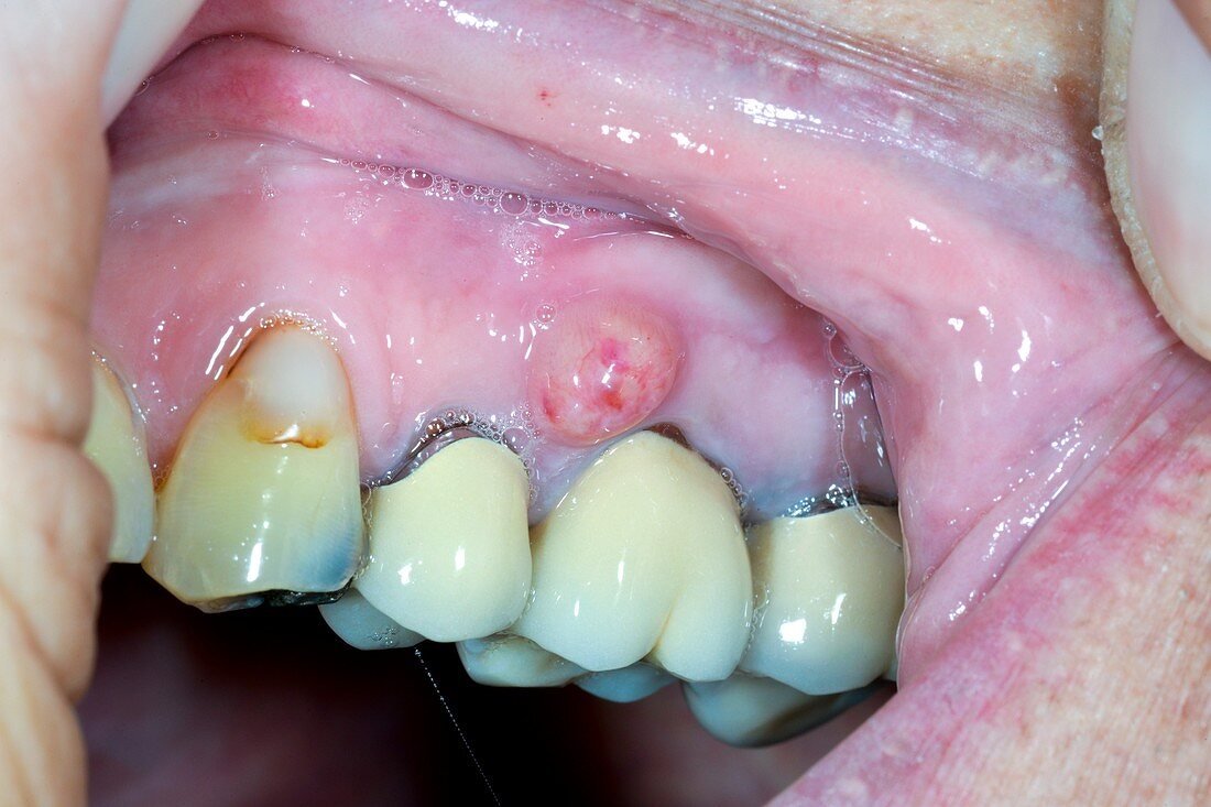 Dental sinus