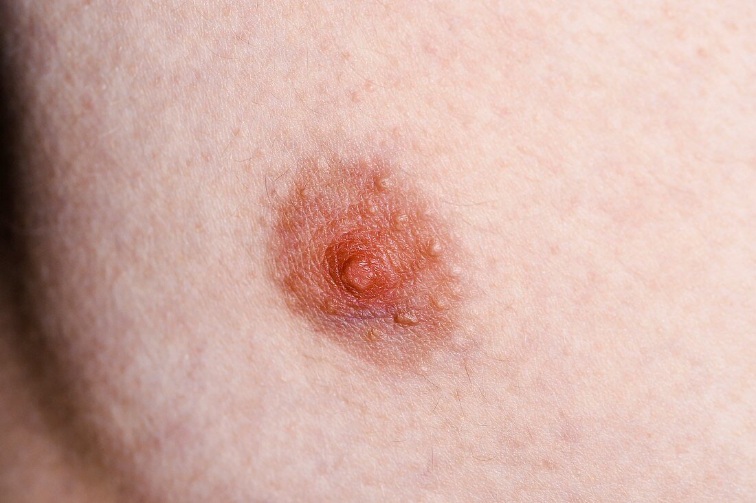 Normal male nipple